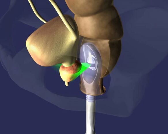 vpliv ultrazvoka na prostato s prostatitisom