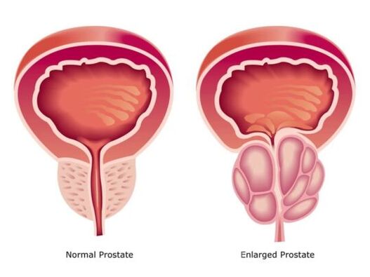 Normalna in povečana prostata