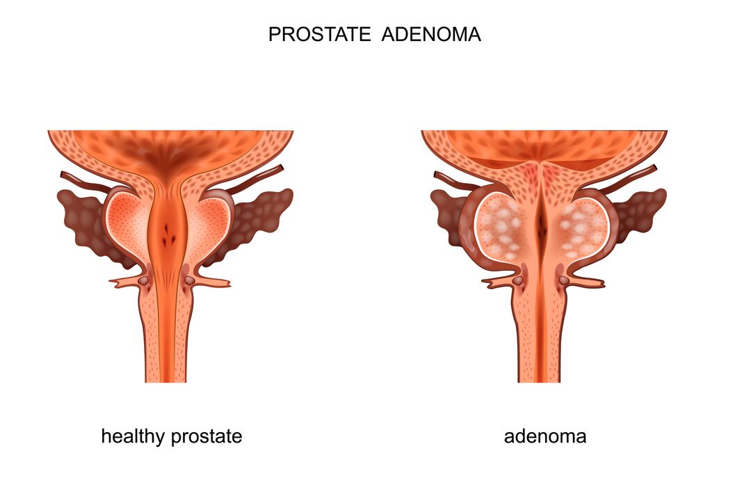 zdrava prostata in z adenomom